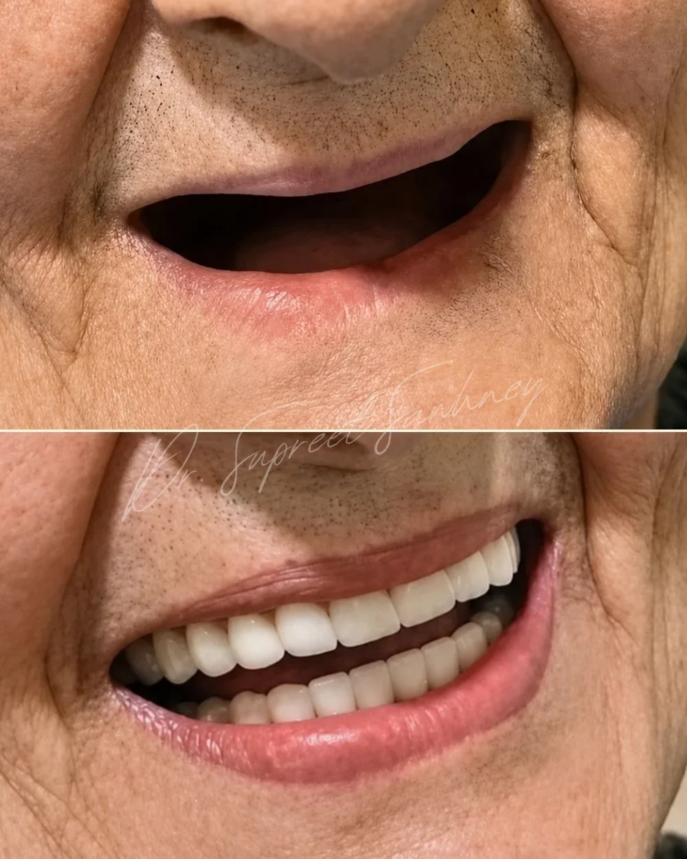 Before-and-after patient smile photographs following mandibular implant-retained overdenture rehabilitation
